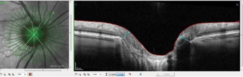 This radial OCT image of the right eye shows a commonly seen steep nasal margin and a more sloping inferotemporal margin.