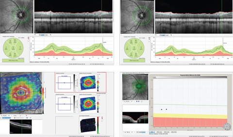 Top row, temporal-superior-nasal-inferior-temporal RNFL circle scans of two different diameters, with the top right image showing the circle scan obtained at a 4.7mm diameter scan. Bottom row left, this macular ganglion cell layer thickness change map of the patients right eye shows stability. Bottom right, this IT BMO OCT scan with minimum rim shows stability over time.