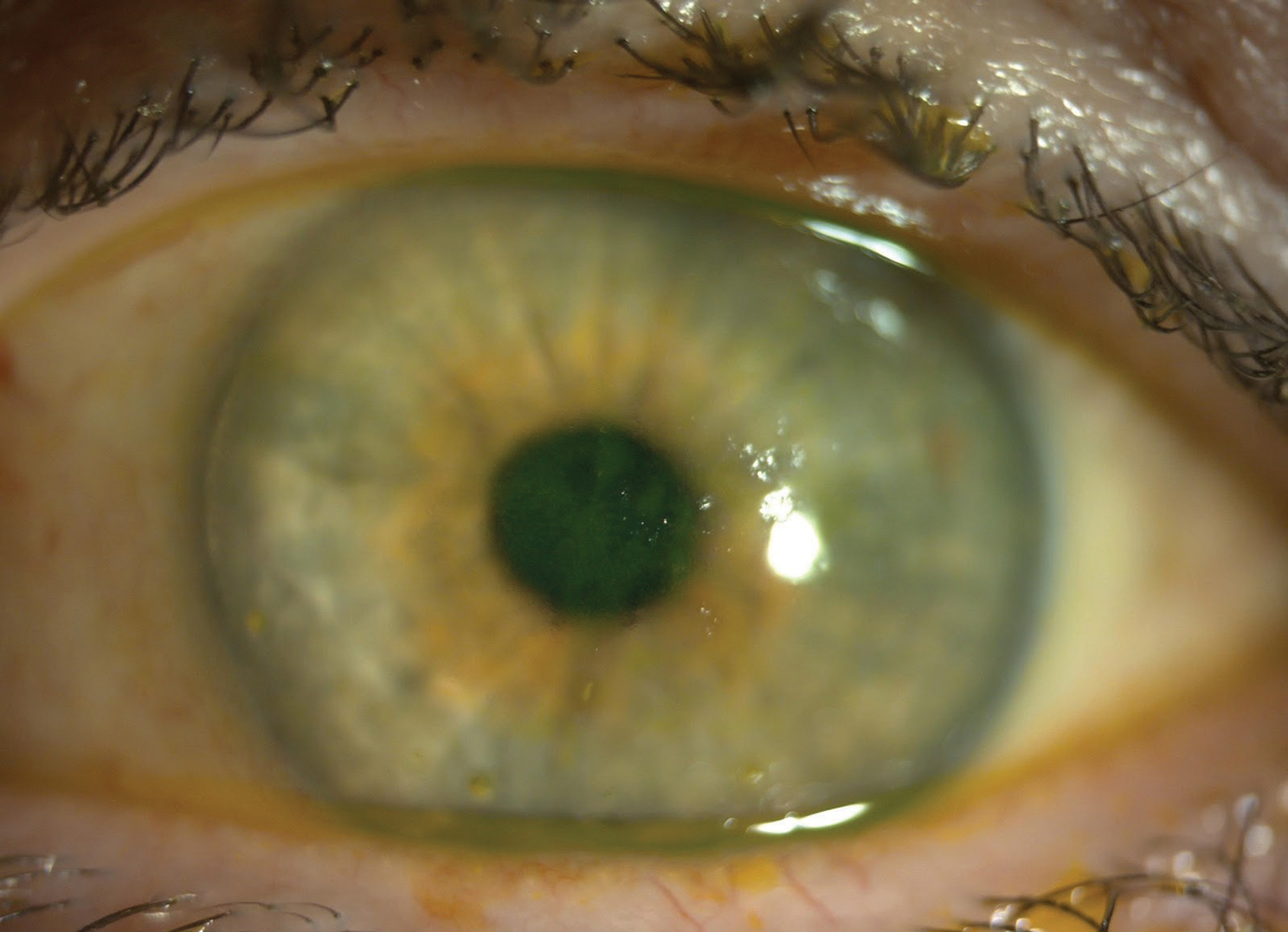 This patient with both SS and lupus has central fluorescein staining. The central coalesced superficial punctate keratitis is causing decreased vision and discomfort. 