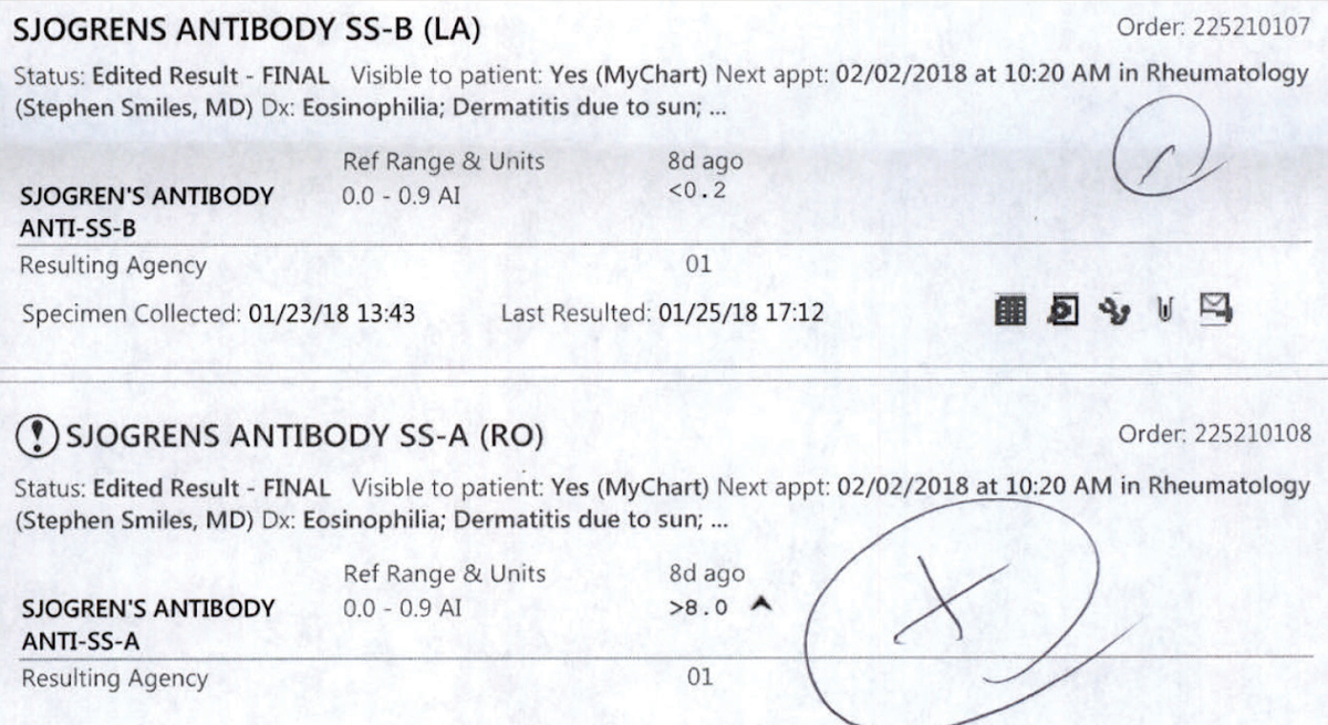 These lab results for a patient sent for Sjögren’s bloodwork are postitive for SS-B and SS-A antibodies.