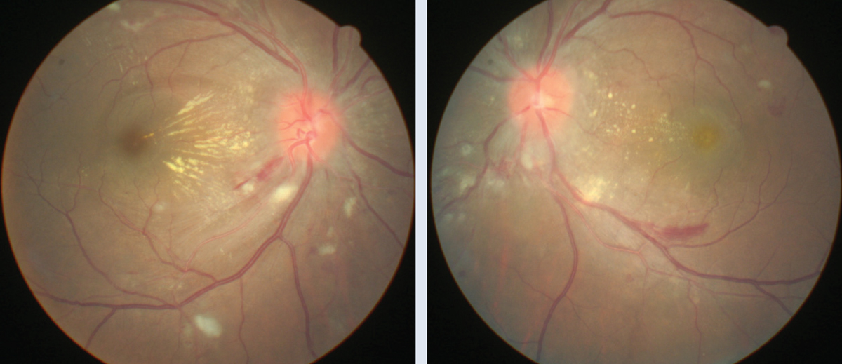 Figs. 1 and 2. The patient’s fundus photos show signs of hypertensive retinopathy, prompting the decision to test for secondary hypertension and pheochromocytoma. 
