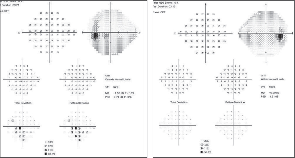 Fig. 3. In the baseline 24-2 SAP, the left eye shows an inferior arcuate close to fixation with central involvement. The right eye shows a normal baseline SAP 24-2.