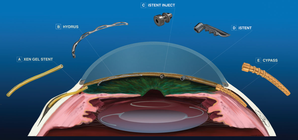 Fig. 1. Each of these MIGS procedures can reduce IOP, but in distinctly different ways.