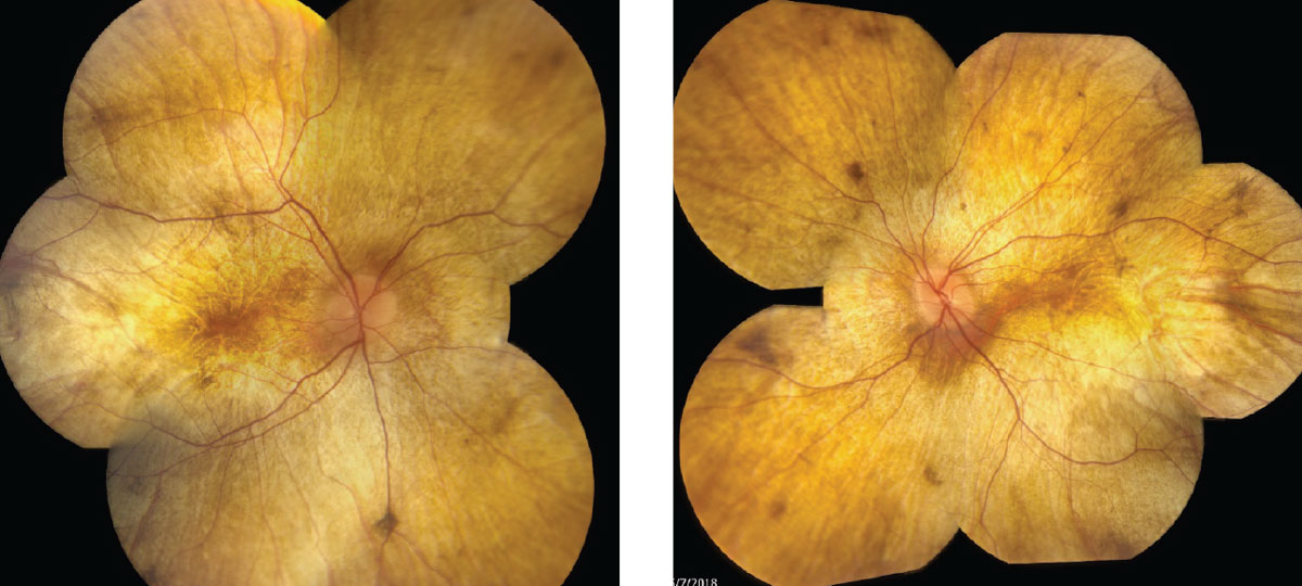 Fig. 1. Fundus photos show our 34-year-old patient’s right, at left, and left eyes.