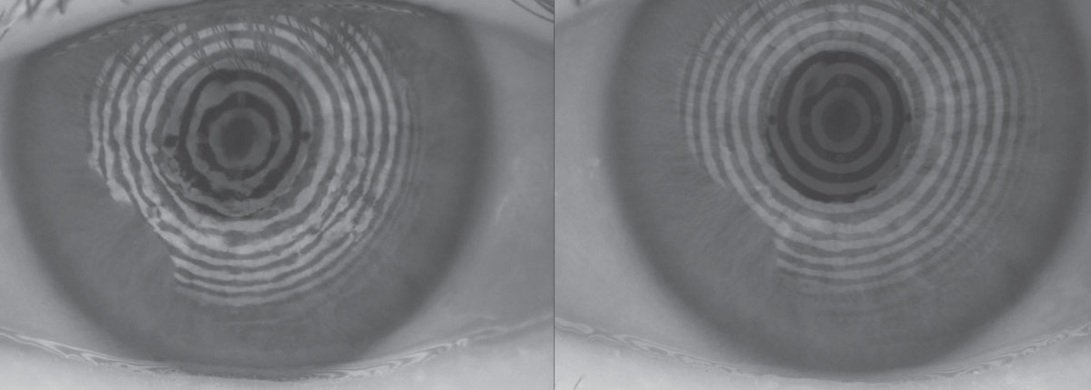 Fig. 1. The restoration of a smooth corneal and refractive surface can be seen in these before, at left, and after placido ring reflections after amniotic membrane therapy. 