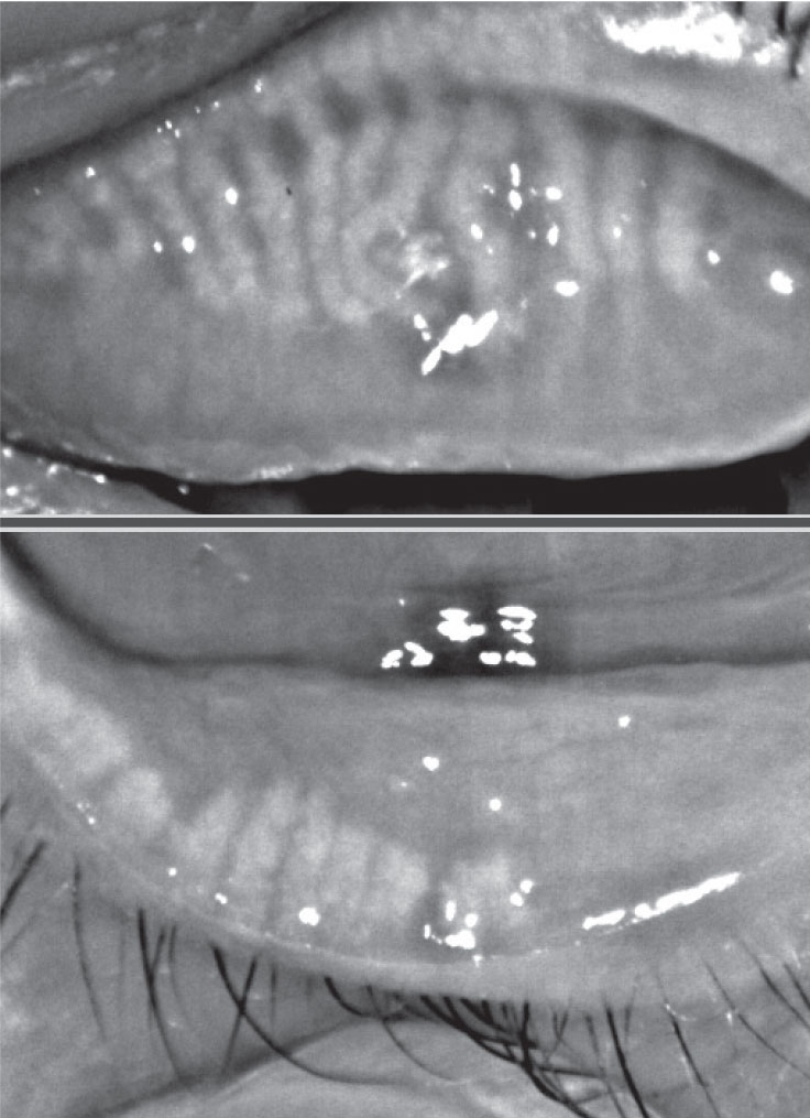 Fig. 2. This patient with 75% meibomian gland atrophy may benefit from in-office MG expression.