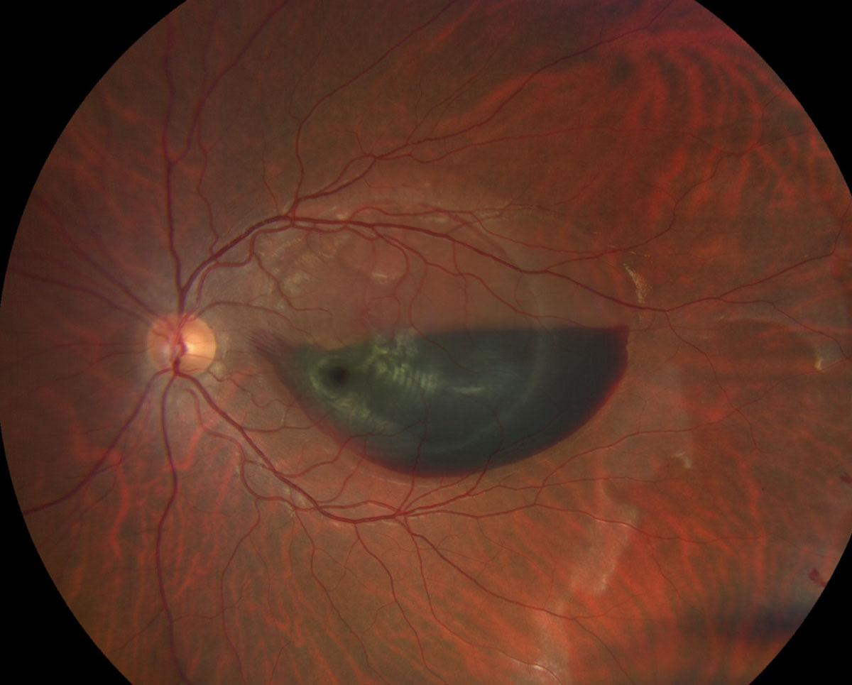 Fig. 1. A view of the macula and posterior pole of the left eye of our patient. How would you characterize the hemorrhage? 