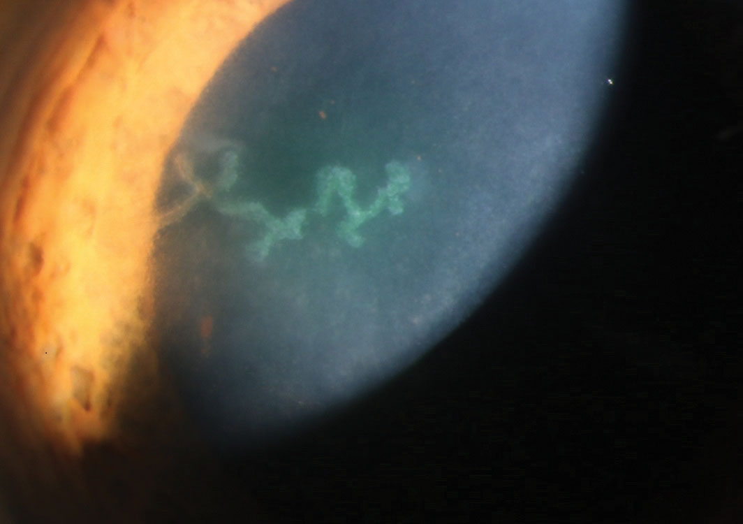 Fig. 1. This patient demonstrates active herpetic dendrite as seen using sodium fluorescein staining.
