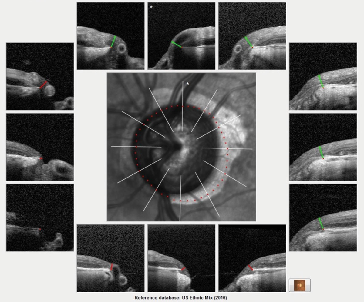 The Bruch’s membrane overview printout for this patient shows advanced glaucomatous damage. This image helps get a ‘global’ picture of the neuroretinal rim. The actual scanning of the optic nerve obtains many more images and is more clinically detailed. Each scan measures the ganglion cells inside the optic nerve, specifically in the neuroretinal rim. A reduction in the thickness reading is consistent with progressive ganglion cell loss.