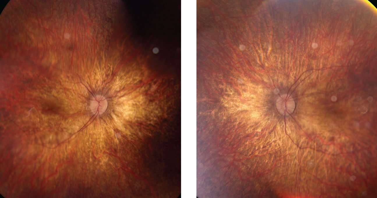 Right and left eyes of our young patient showing an ultra-widefield view of the posterior pole and periphery. What pathology could explain his blurry vision?