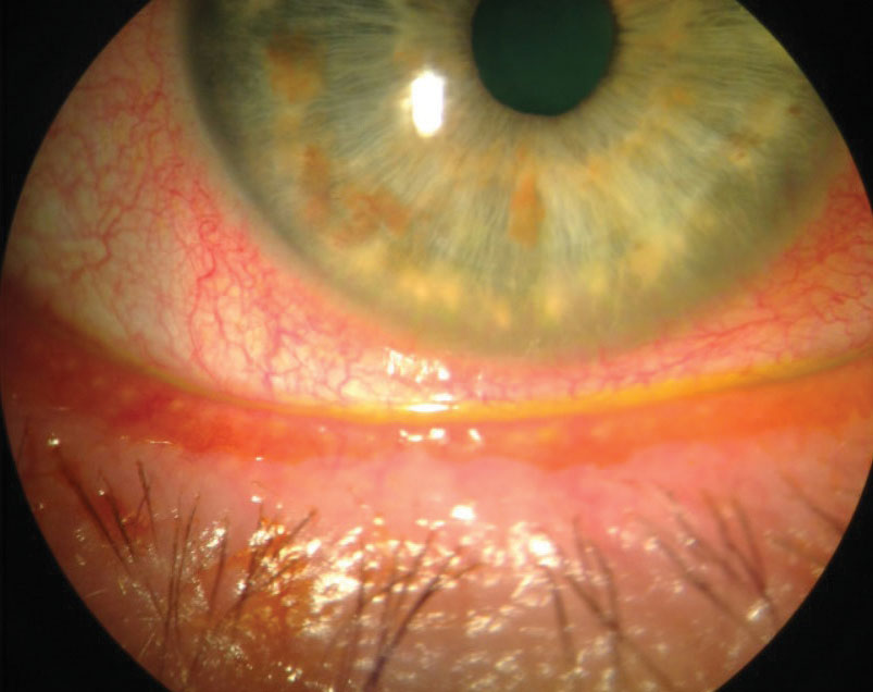Fig. 1. Conjunctival hyperemia is an excellent marker of ocular surface inflammation. A new topical steroid may help reduce this DED sign. 
