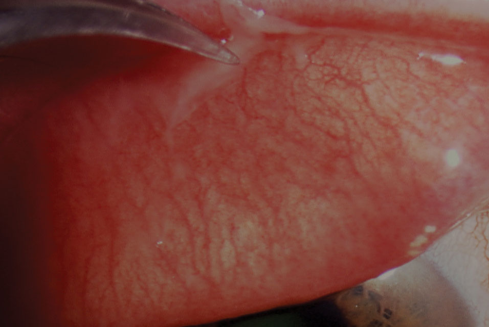Fig. 2. Forceps removal of a pseudomembrane in viral conjunctivitis.