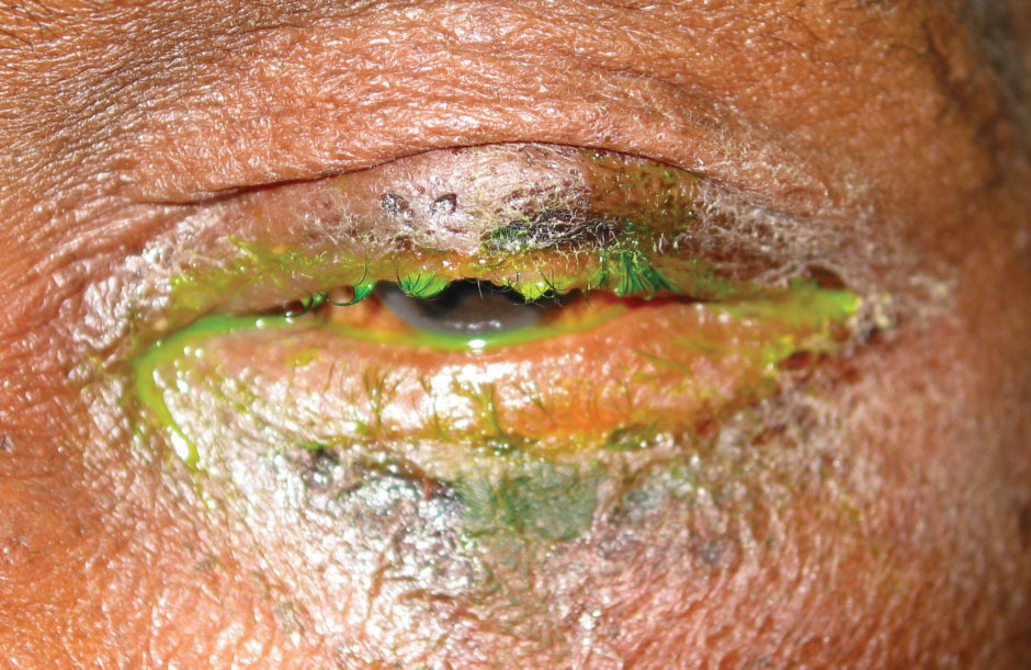 Fig. 3. Madarosis and purulent discharge in a patient with a bacterial infection. 