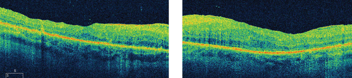 Fig. 2. These OCT images illuminate specific findings along the layers of the posterior segment, including the choroid.