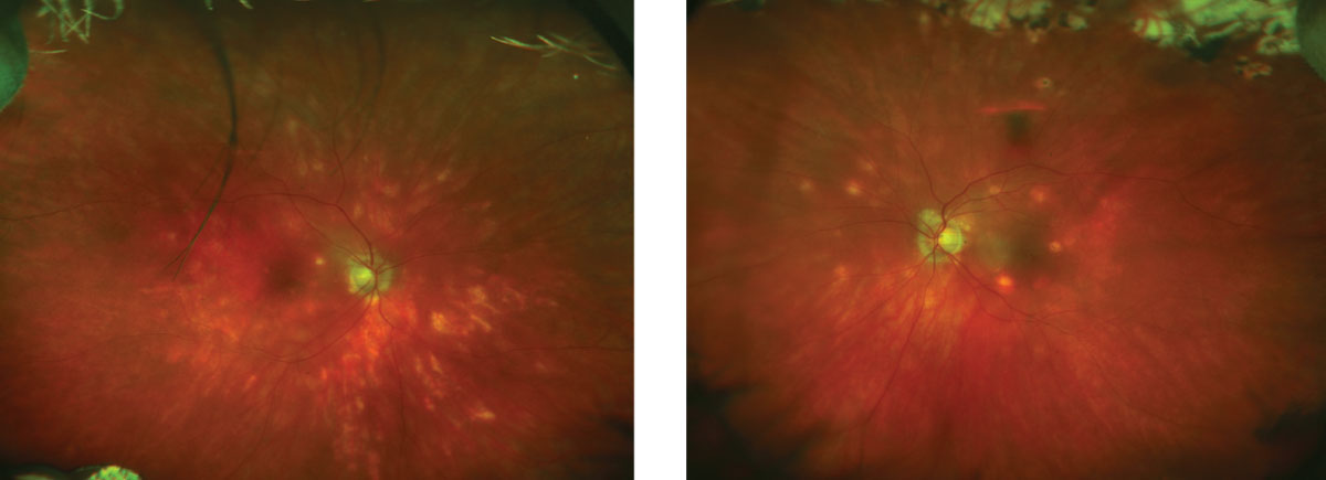 These fundus images show the patient four years following her initial diagnosis.