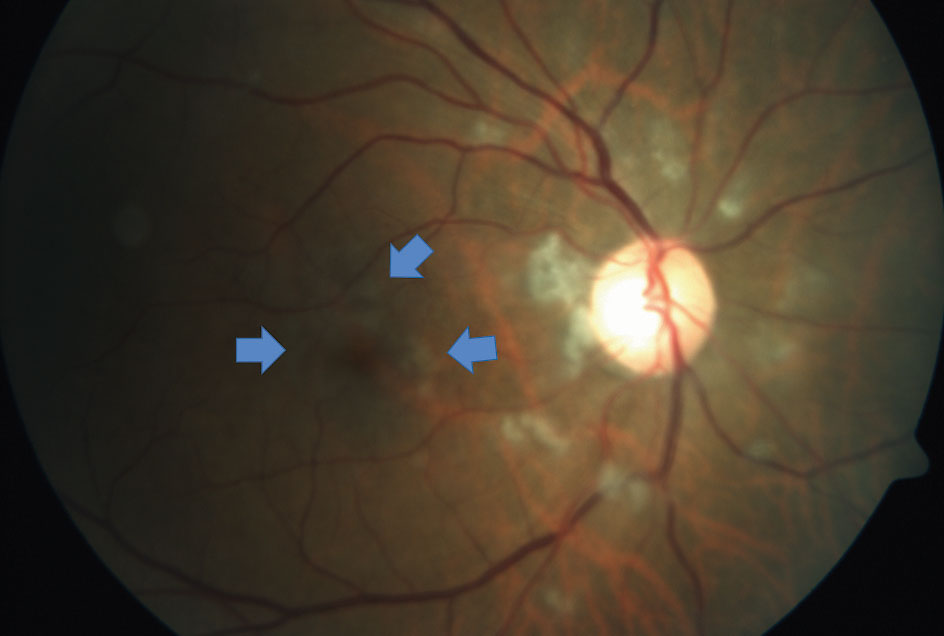 Fig. 1. This right eye fundus photograph documents the presence of cotton-wool spots surrounding the optic nerve. More subtle signs of ischemia surround the fovea (arrows). Vessel caliber appeared mostly symmetrical with the unaffected eye.