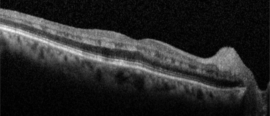 Fig. 2. Hyperreflective bands in the inner nuclear layer consistent with paracentral acute middle maculopathy.