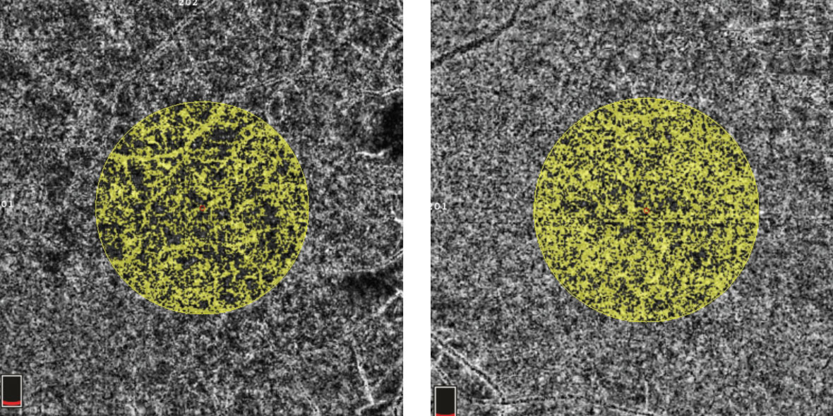 Fig. 4. In this OCT-A image, the right eye (left) shows a choriocapillaris flow area of 3.763mm2 surrounding the fovea in an examiner-selected area of 7.114mm2. The left eye has an increased flow area of 4.686mm2 within the same area.