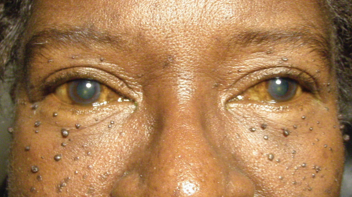 This 67-year-old woman is suffering from both skin lesions and blurry vision. Can you identify the cause of her visual disturbances?