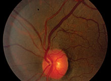 Can You Spot These Retinal Vascular Abnormalities?